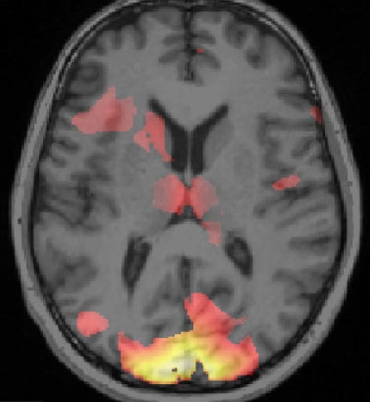 Image shows a brain scan.