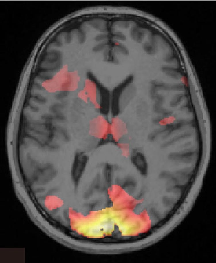 Image shows a brain scan.
