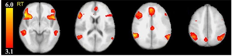Image shows brain scans.
