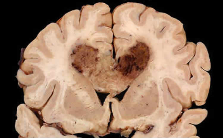 Image shows a brain slice with a glioblastoma brain tumor.
