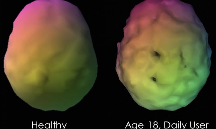 Image shows brain scans of a healthy person and a daily marijuana user, aged 18.