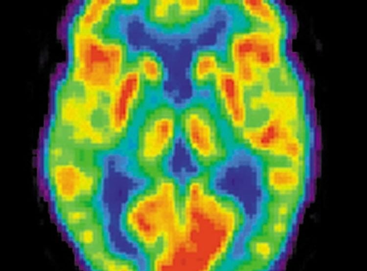 Image shows a PET scan.