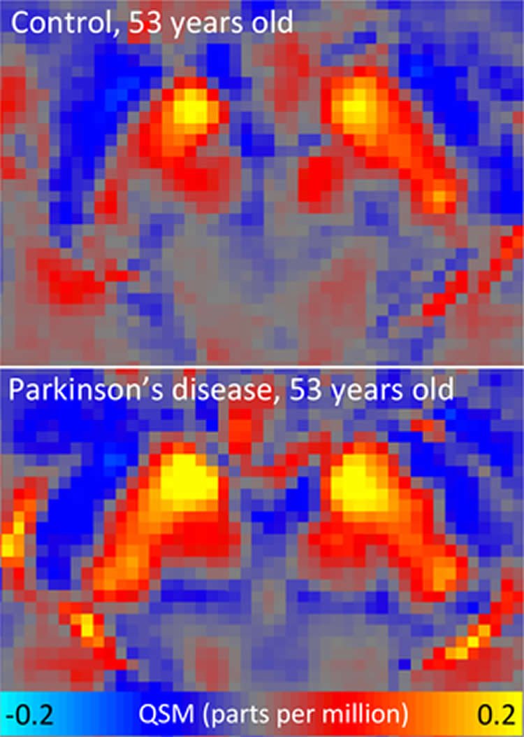 Image shows iron content in both a parkinson's patient's brain and that of a person without the disease.