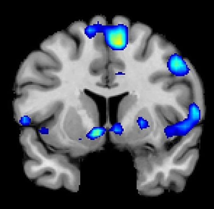 Image shows a brain scan with the nac highlighted.