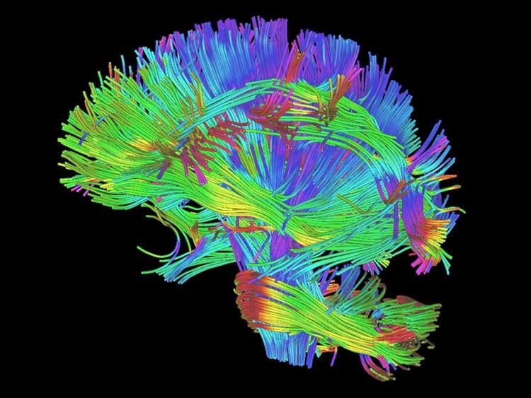 Image shows the white matter rendering from DTI.