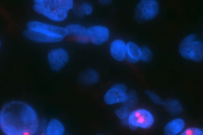 Image shows glioma cells.