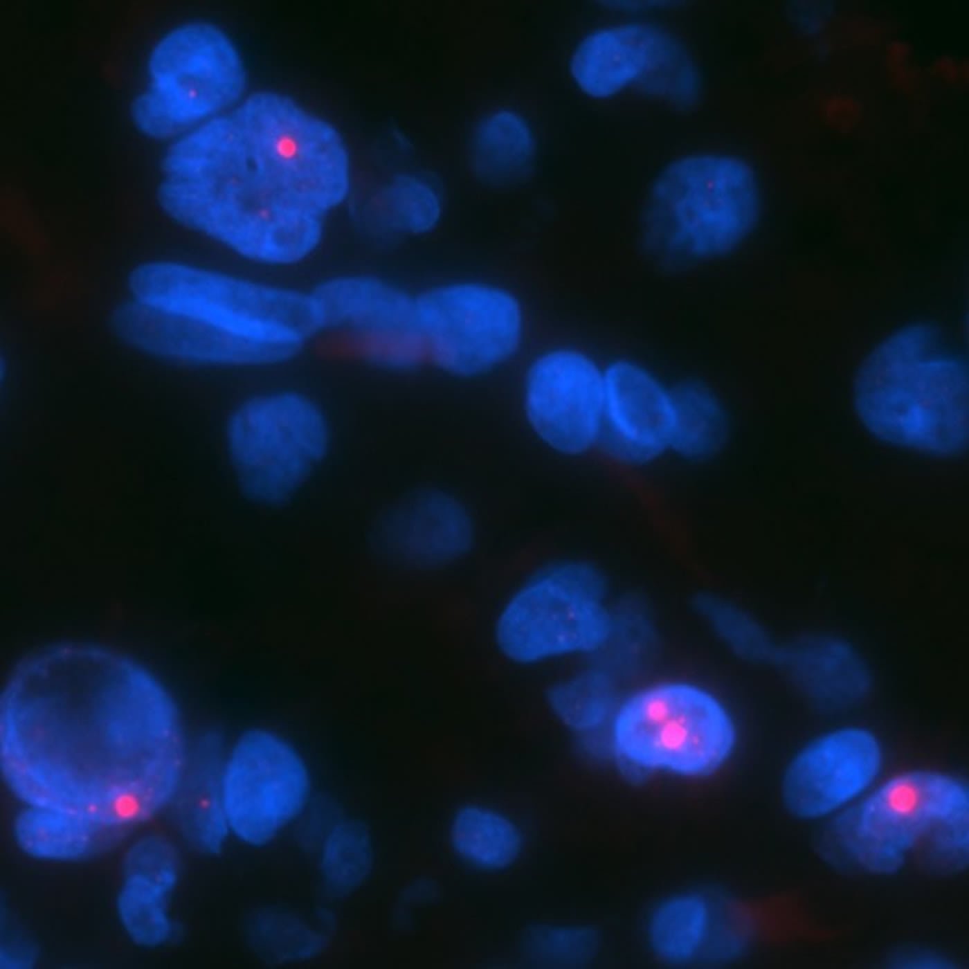 Image shows glioma cells.