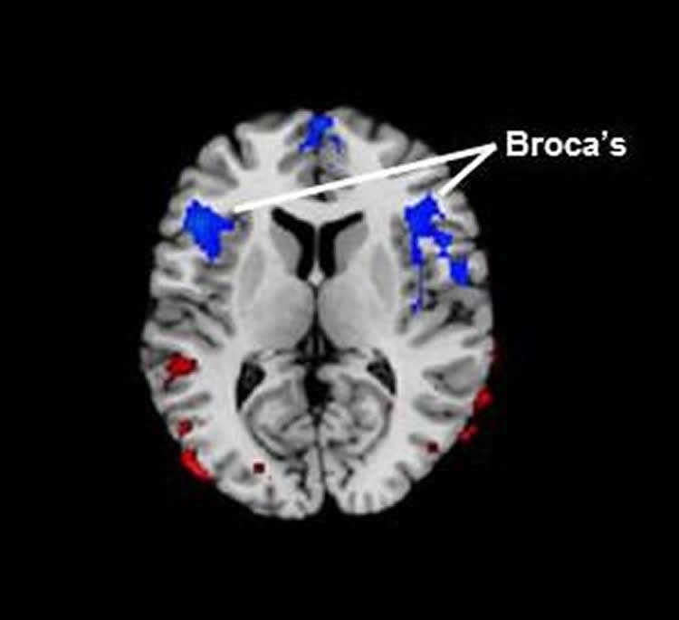 Image shows a brain scan with the Broca's area highlighted.