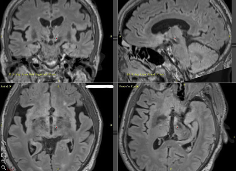 Image shows brain scans.