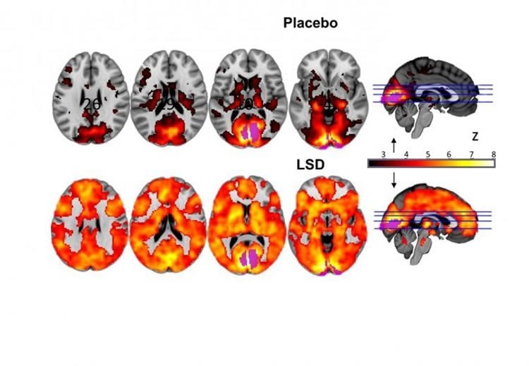 LSD brain