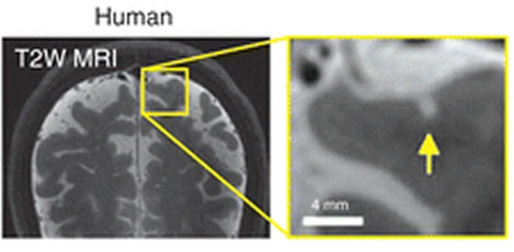 Image shows a microinfarct in the human brain.