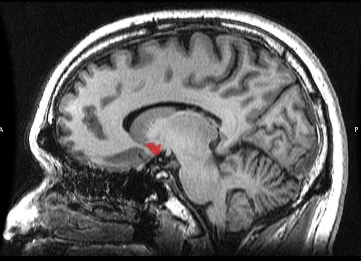 Image shows the location of the nucleus accumbens in the brain.