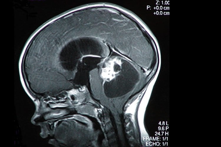 Image shows a brain scan of a child with a brain tumor.