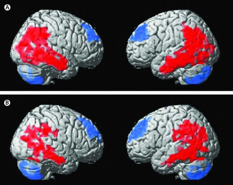 Image shows brain scans.