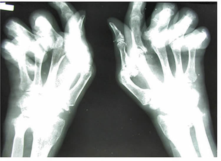 Image shows an X-ray of a person's hand with RA.