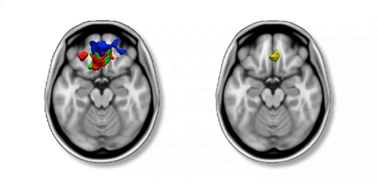 Image shows brain scans of people with ADHD.