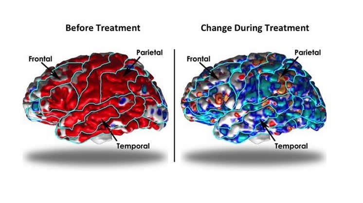 brain scan depression