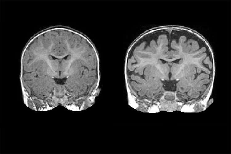 Image shows MRI brain scans.