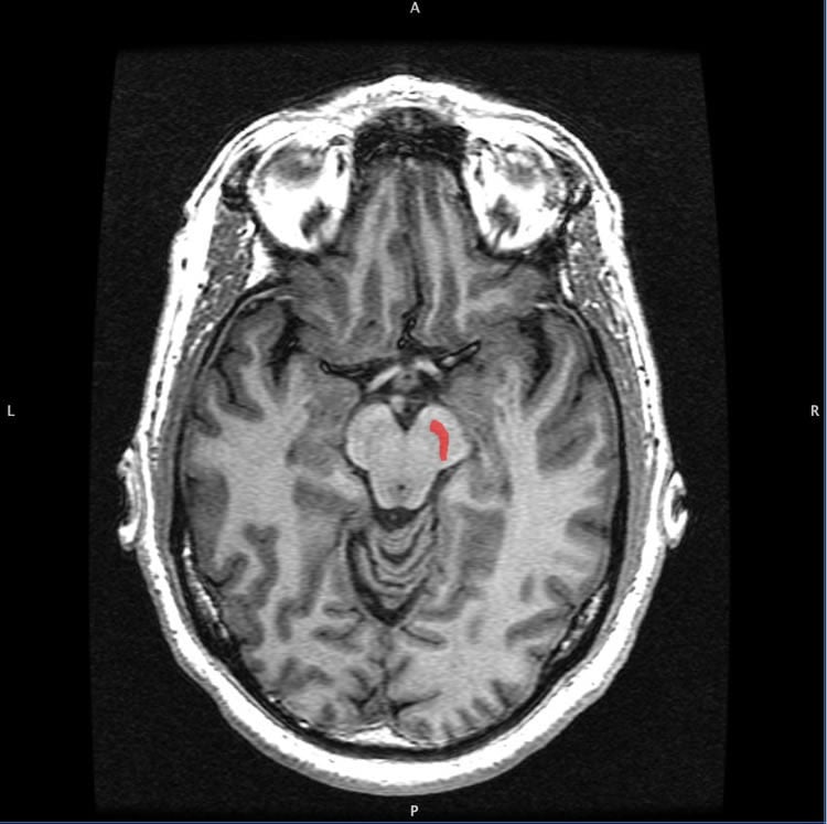Image shows a the location of the substantia nigra in the brain.