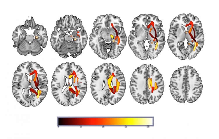 Image shows the brain regions machine learning has picked up as associated with depression.