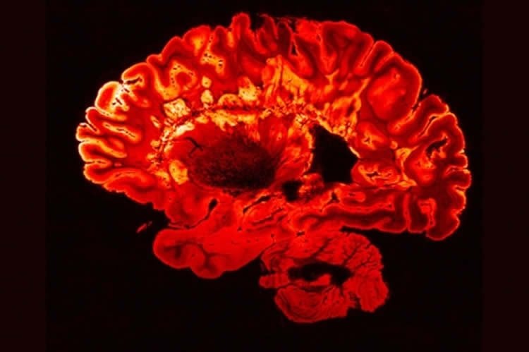 Image shows a brain scan of a person with multiple sclerosis.