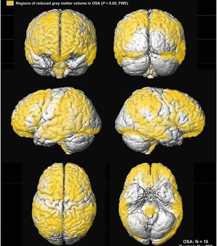 Image shows brain scans of kids with sleep apnea.
