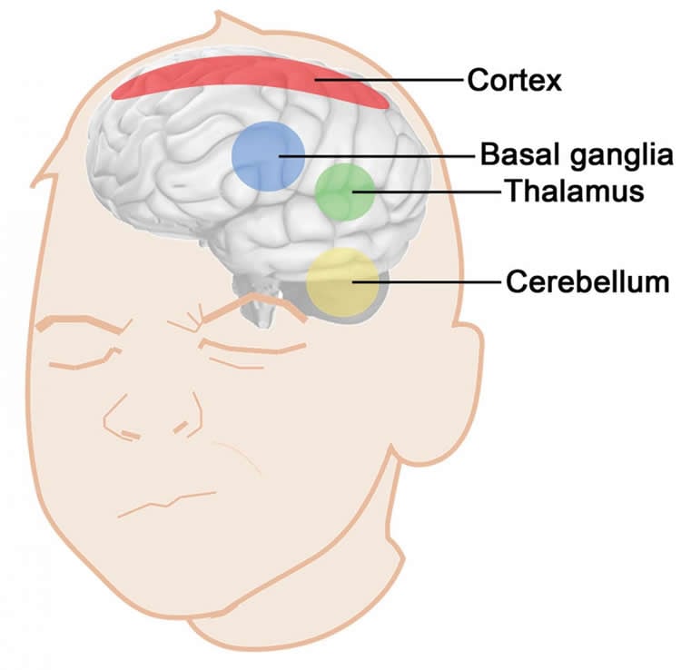 Image shows brain areas associated with tourette tics.