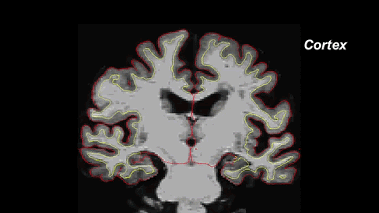 Image shows brain shrinkage is an aging brain.