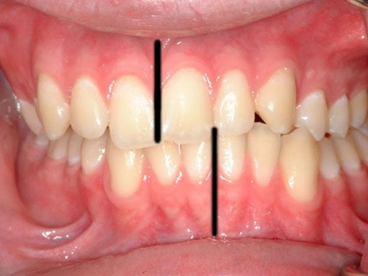 Image shows teeth.