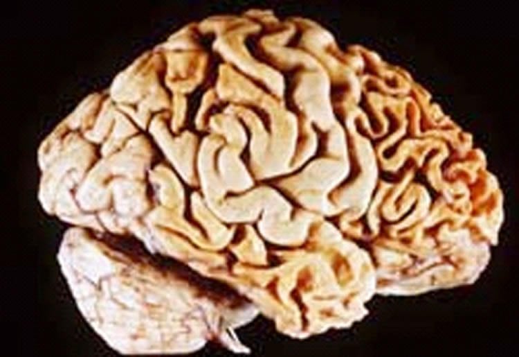 Image shows a brain of a person with frontotemporal dementia.