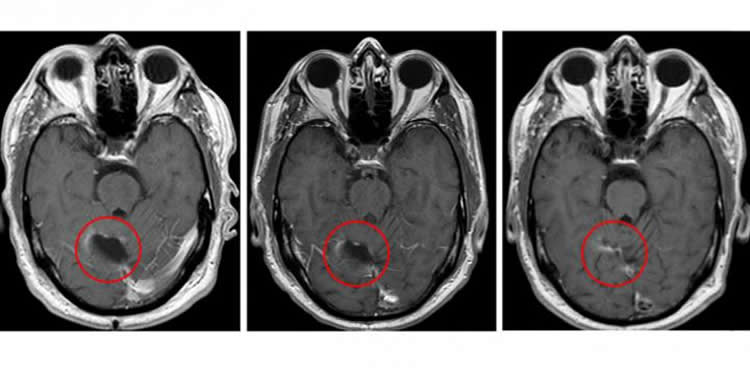 Image shows a brain scan from a glioblastoma patient.