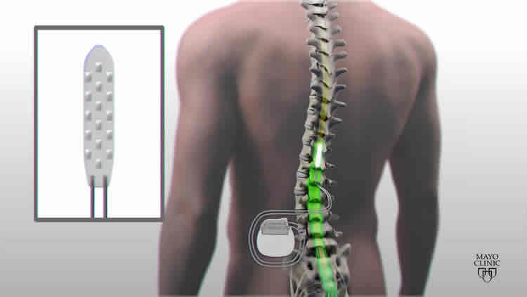 Image shows the spinal cord stimulation device and a drawing of a spine.