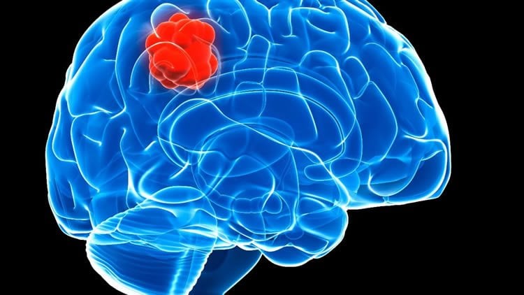 Image shows a brain and a red lump.