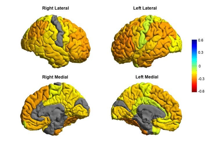 Image shows brain scans of bipolar patients.
