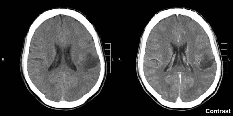 Image shows brain scans of a glioma brain tumor.