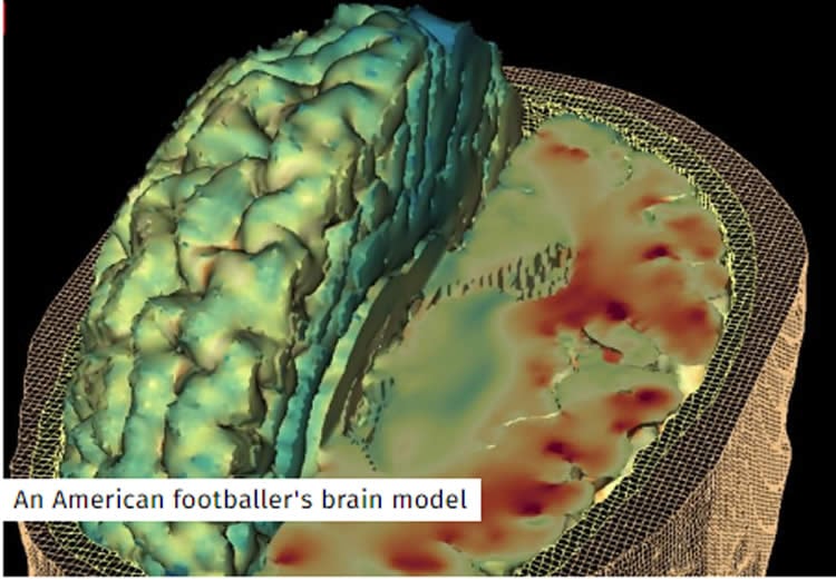 Image shows a brain model of an NFL player.