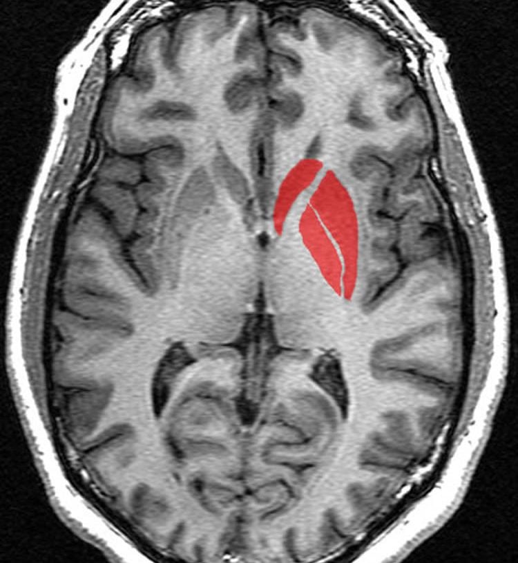 Image shows the location of the striatum in the brain.