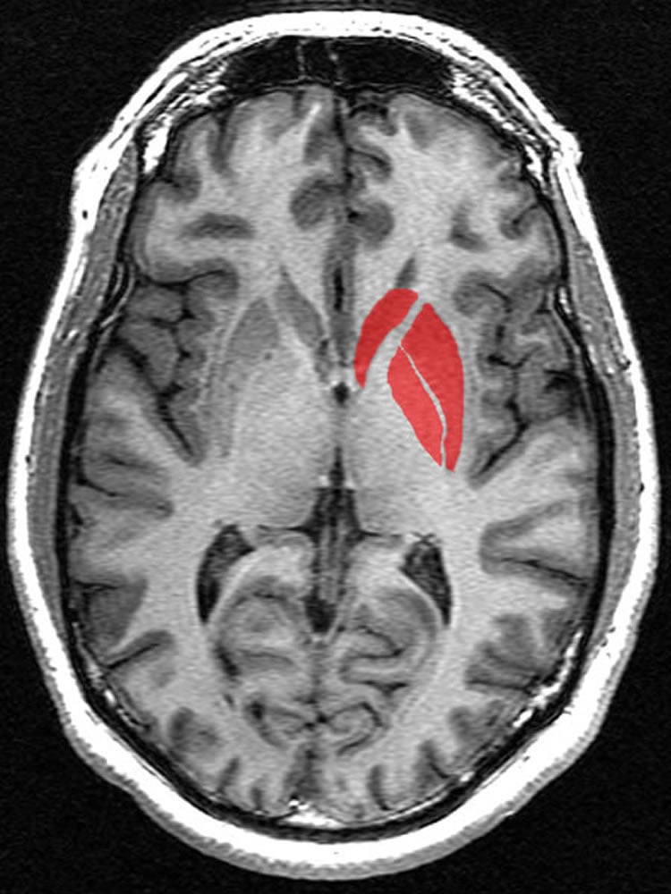 Image shows the location of the striatum in the brain.