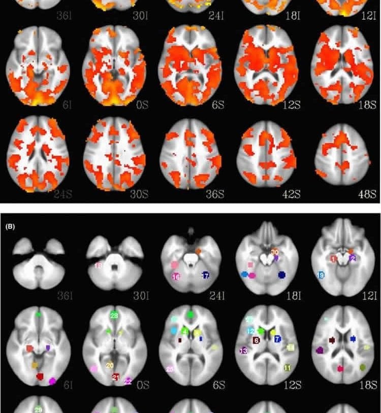 Image shows brain scans of a person with bipolar disorder.