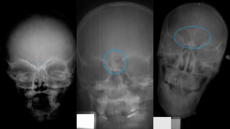 Image shows skull x-rays.