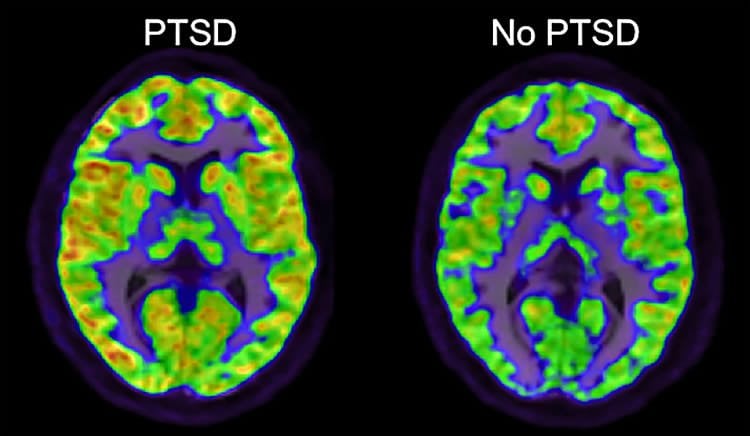 Image shows brain scans of a normal and PTSD brain.