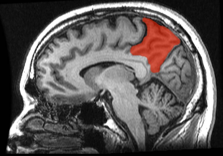 Image shows the location of the prencueus in the brain.