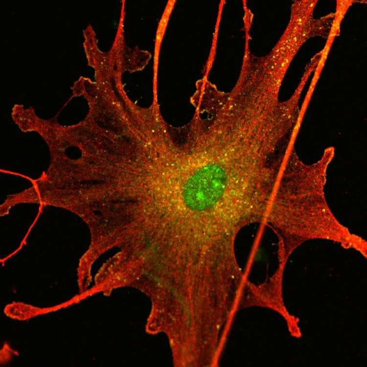 Image shows a schwannoma tumor cell.