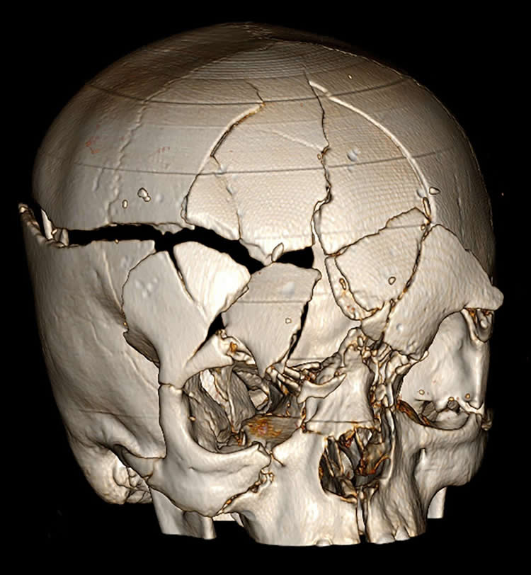 Image shows a smashed up skull.