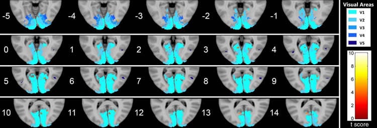 Image shows brain scans with the occipital cortex highlighted.