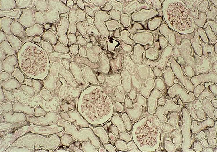 Image shows tumor cells.