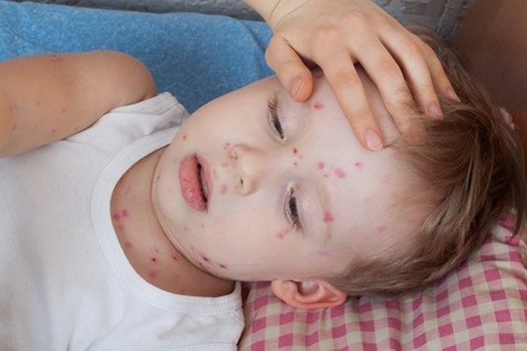 Image shows a small child with chickenpox.