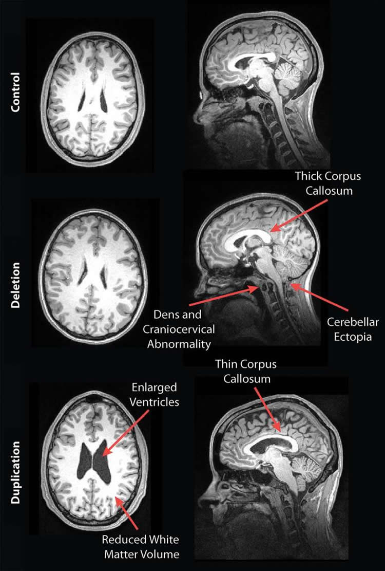 Image shows brain scans of people with genetic autism.