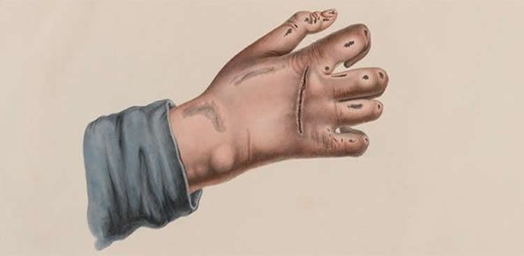 Image shows defored hand.
