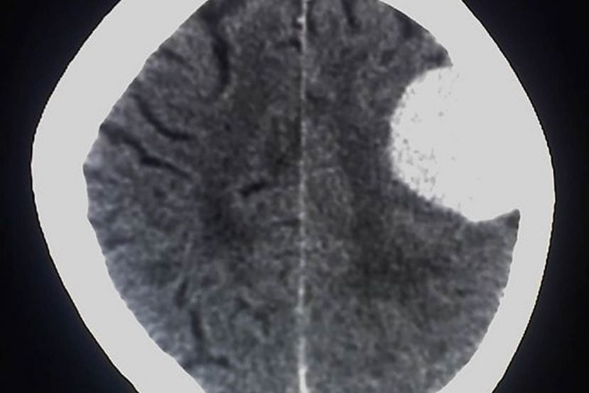 Image shows brain scan of a meningioma brain tumor.